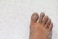 Ingrown nail Big toe broken toenail on a terrazzo floor background Royalty Free Stock Photo