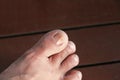 Ingrown nail Big toe selective focus, broken toenail on wood floor Royalty Free Stock Photo