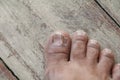 Ingrown nail Big toe selective focus, broken toenail on wooden Royalty Free Stock Photo