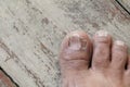 Ingrown nail Big toe selective focus, broken toenail on wooden Royalty Free Stock Photo