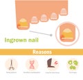 Ingrown nail. Vector.