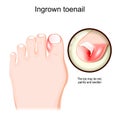 Ingrown toenail. Human foot