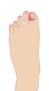 Ingrown toenail left foot, illustration on white background