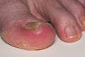 Ingrown toenail onychocryptosis on caucasian big toe Hallux, caused by fungal infection tinea unguium.