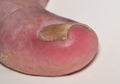 Ingrown toenail onychocryptosis on caucasian big toe. Royalty Free Stock Photo