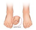 Ingrown toenail or onychocryptosis that occurs when the nail edge grows into the periungual dermis. Nail disease. Vector