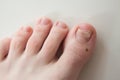 Ingrown toenail treatment. The results of drugs for the treatment of fungal infections and ingrown nails. Bracket