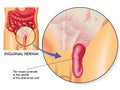 Inguinal hernia Royalty Free Stock Photo