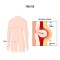 Inguinal Hernia. bowel exit through the wall of the abdomen cavity