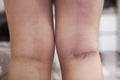 The initial stage of varicose veins, pain in the legs Royalty Free Stock Photo