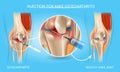 Injection for Knee Osteoarthritis Medical Chart