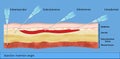 Injection insertion angle