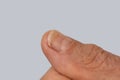 injured finger, nail damage from impact, compression, tear, part of male finger injury close-up, bruise, industrial or domestic