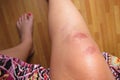 Injured Knee Royalty Free Stock Photo