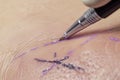 ink pen marking skin for incision