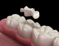 Inlay ceramic crown fixation over tooth. Medically accurate 3D illustration of human teeth