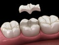 Inlay ceramic crown fixation over tooth. Medically accurate 3D illustration of human teeth treatment