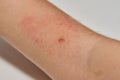 Insect bite on arm of child Royalty Free Stock Photo