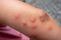 Insect bites on female hand