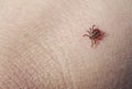 Dangerous insect mite crawls on human skin causing various infectious disease Royalty Free Stock Photo