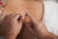 Inserting Acupuncture Needles Royalty Free Stock Photo