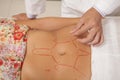 Inserting Acupuncture Needles