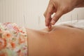 Inserting Acupuncture Needles, close- Up Royalty Free Stock Photo