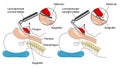 Inserting a laryngoscope Royalty Free Stock Photo
