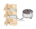 Insertion of artificial disc. Disc Replacement Artificial Disc. Arthroplasty