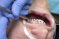 The installation of braces. Alignment of the dentition or bite. Tweezers in the hands of a doctor. The concept of beauty and