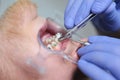 The installation of braces. Alignment of the dentition or bite. Tweezers in the hands of a doctor. The concept of beauty and