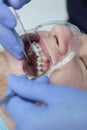 The installation of braces. Correction of malocclusion or dentition. Tweezers in the hands of an orthodontist. Vertical photo.
