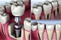 installation of a metal pin for a dental implant illustration Generative AI