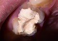 Installation of a temporary filling in the treatment of tooth canals, endodontics. Tooth pulpitis in dentistry, macro Royalty Free Stock Photo