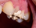 Installation of a temporary filling in the treatment of tooth canals, endodontics. Tooth pulpitis in dentistry, macro