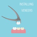 The installation of the veneer. Alternative to bleaching. Cosmetic dental procedure, Aesthetic dentistry, modern medicine. Veneers