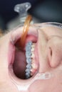 Installing braces on the upper row of teeth.Alignment of the dentition or bite. The concept of beauty and health. Macro