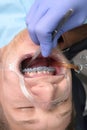 Installing braces on the upper row of teeth.Alignment of the dentition or bite. Tweezers in the doctor`s hand. The