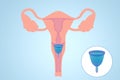 Instruction how to use menstrual cup during period. Female reproductive system on light blue background, illustration