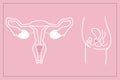 Instruction how to use menstrual cup during period. Female reproductive system on pink background, illustration