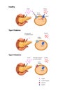 Insulin action and diabetes type 1 and 2, 2d 3d graphic, render