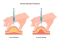 Insulin injection technique. Correct and incorrect way. Cross-section