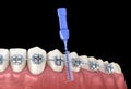 Interdental tooth brush and braces cleaning. Medically accurate illustration of oral hygiene