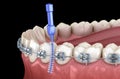 Interdental tooth brush and braces cleaning. Medically accurate 3D illustration of oral hygiene