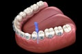 Interdental tooth brush and braces cleaning. Medically accurate 3D illustration of oral hygiene