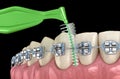 Interdental tooth brush and braces cleaning. Medically accurate 3D illustration of oral hygiene