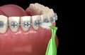 Interdental tooth brush and braces cleaning. Medically accurate 3D illustration of oral hygiene