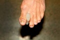 Interdigital pads. partitions. Foot. Corn on toes. Curvature of fingers. Interdigital Corn pad. Royalty Free Stock Photo