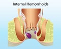 Internal hemorrhoid. Unhealthy lower rectum with inflamed vascular structures