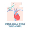 Internal jugular central venous catheter close up